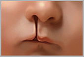 Unilateral Cleft Lip,Illustration