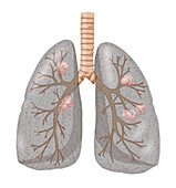 Lung Cancer,Illustration