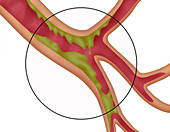 Bronchitis,Illustration