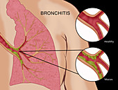 Bronchitis,Illustration