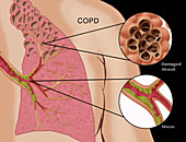Chronic Pulmonary Disease,Illustration