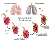 Lung Damage and Emphysema,Illustration