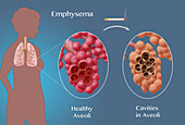 Alveoli,Emphysema,Illustration