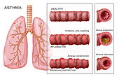 Bronchoconstriction,Asthma,Illustration