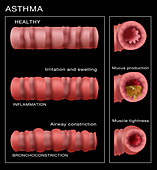 Bronchoconstriction,Asthma,Illustration