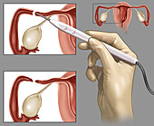 Fallopian Tubes cauterized,Illustration