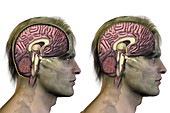 Brain,Hyponatremia,Illustration