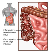 Crohn's Disease,IBD,Illustration