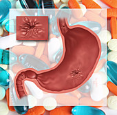 Ulcer from Painkiller Abuse,Illustration