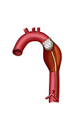 Aortic Stent Insertion,Illustration