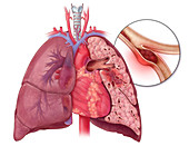 Pulmonary Embolism,Illustration