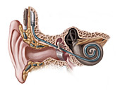 Cochlear Implant,Illustration