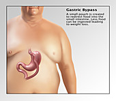 Gastric Bypass Surgery,Illustration