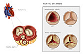 Aortic Valve,Illustration