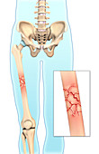 Comminuted Bone Fracture,Illustration