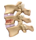 Compression Fracture,Illustration