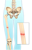 Transverse Bone Fracture,Illustration