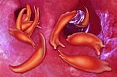 Sickle Cells,Illustration