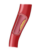 Clogged Artery,3 of 4,Illustration