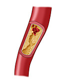 Clogged Artery,5 of 5,Illustration