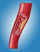 Clogged Artery,3 of 5,Illustration