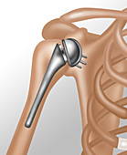 Shoulder Joint Replacement,Illustration