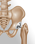 Hip Joint Replacement,Illustration