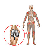 Knee Joint Replacement,Illustration