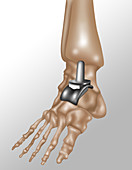 Ankle Joint Replacement,Illustration