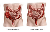 Inflammatory Bowel Diseases,Illustration