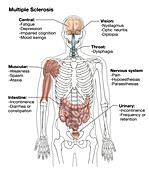 Multiple Sclerosis Symptoms,Illustration