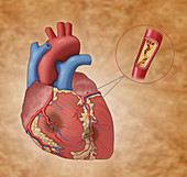 Clogged Artery,Illustration