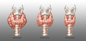 Thyroid Disorders,Illustration