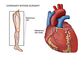 Coronary Bypass Surgery,Illustration