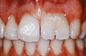 Partially seminated incisor