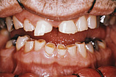 Severe Dental Attrition