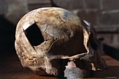 Incan Skull,Cranial Surgery,Cusco,Peru