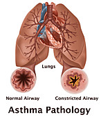 Asthma Pathology,illustration
