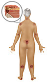Woman with Pressure Sores,Illustration