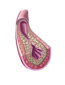 Clogged Artery,illustration