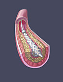 Clogged Artery Stent,illustration