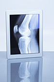 Knee X-ray on Tablet,illustration