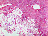 Colloid Liver Tumour,LM