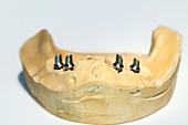 Dental cast with abutments