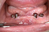 Dental implants,healing abutments