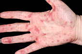 Rash in mycoplasma pneumonia