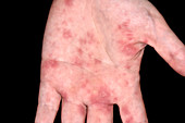 Rash in mycoplasma pneumonia