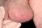 Inflamed testicles