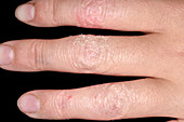 Acute eczema