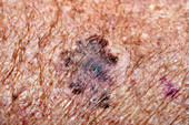 Melanoma skin cancer